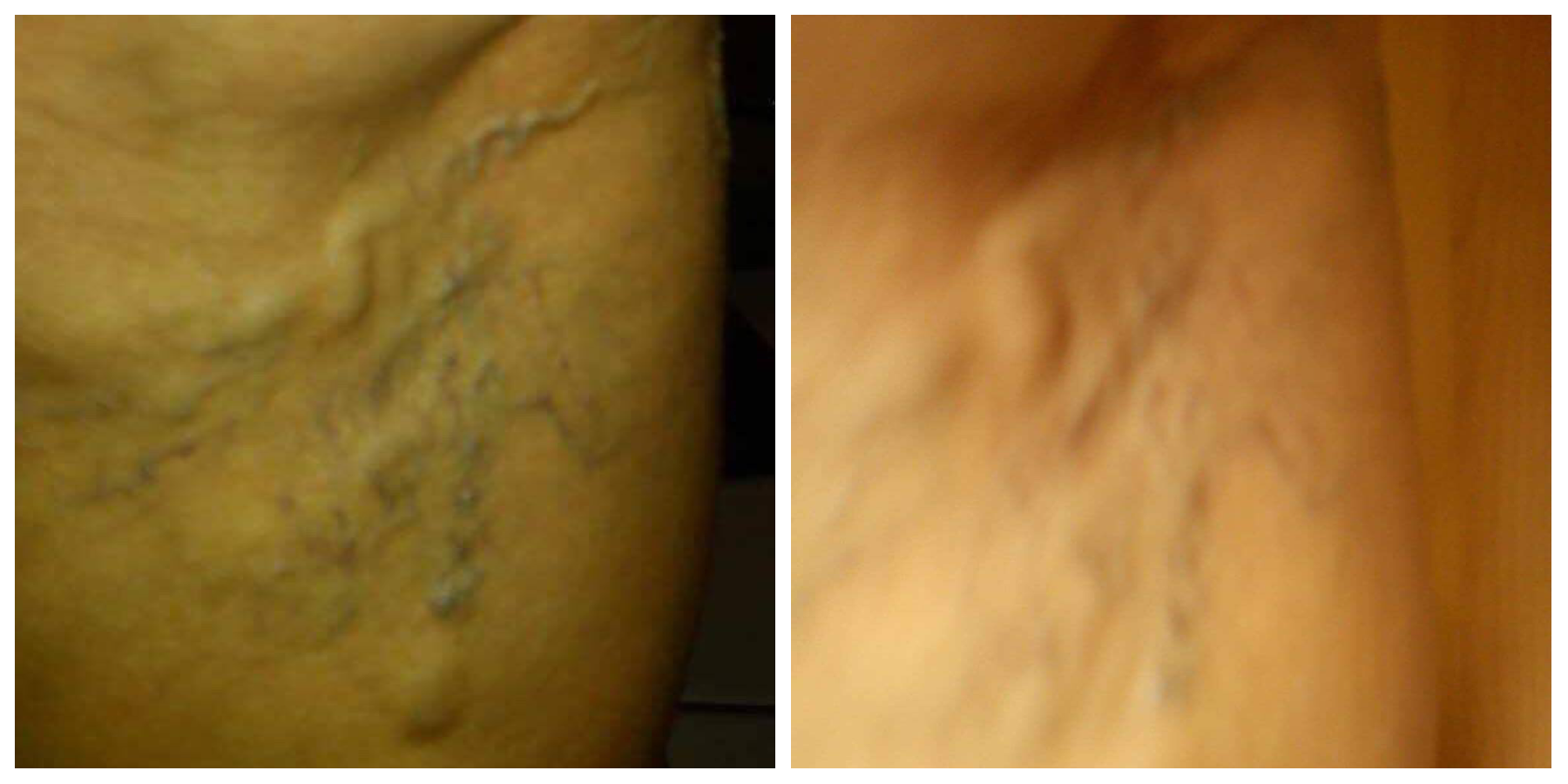 pred a po užívaní varikoflex